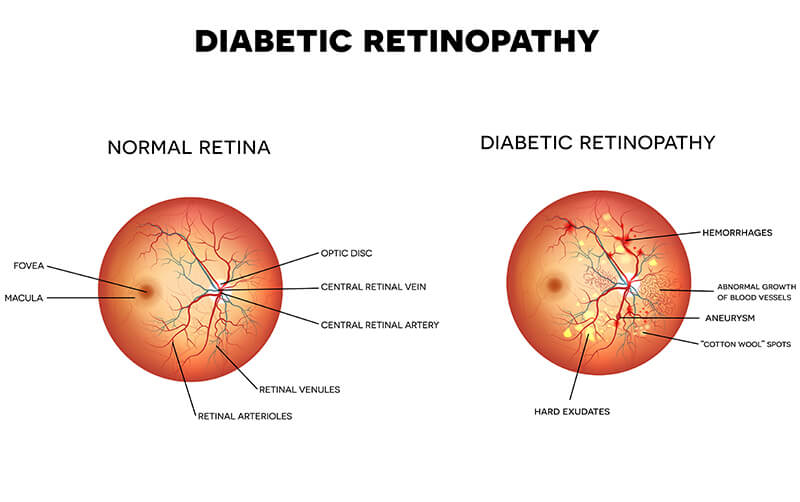Chart Showing an Eye With a Normal Retina Compared to One With Diabetic Retinopathy