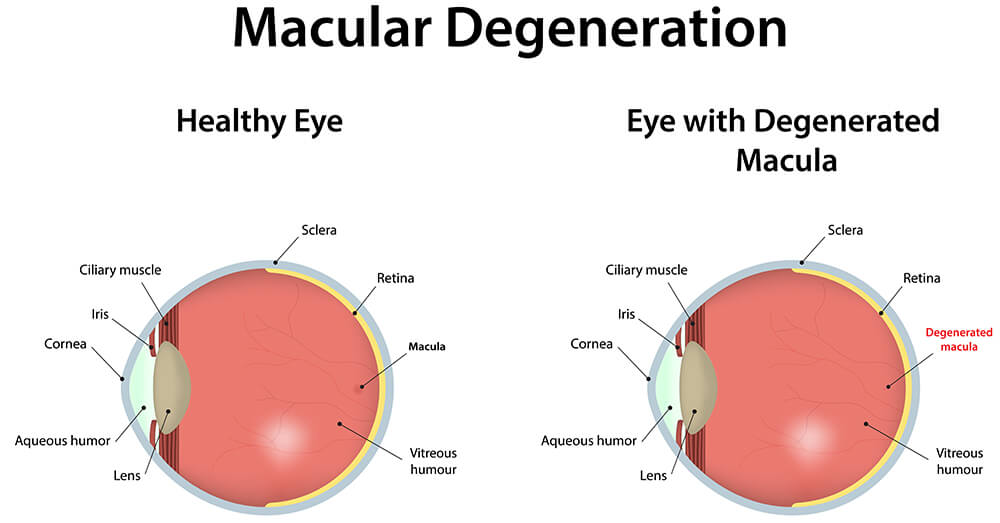 Chart Comparing a Healthy Eye to One With a Degenerated Macula