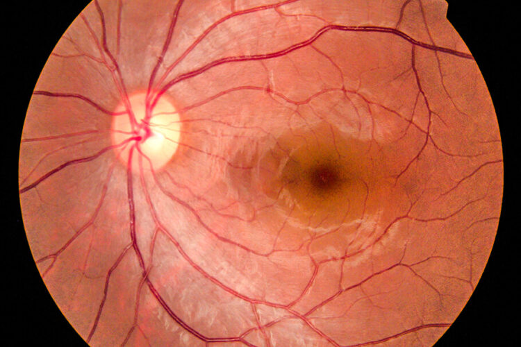 Retinal Detachment Boynton Beach Retina Boynton Beach Joshi