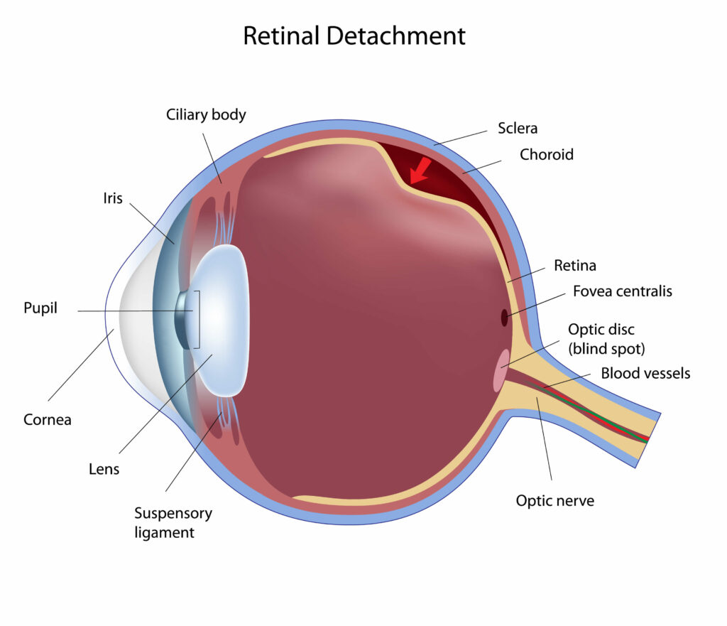 Chart Illustrating a Retinal Detachment in an Eye