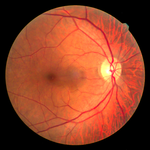 Retina Scan