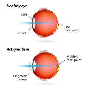 anatomic diagram of an eye with astigmatism